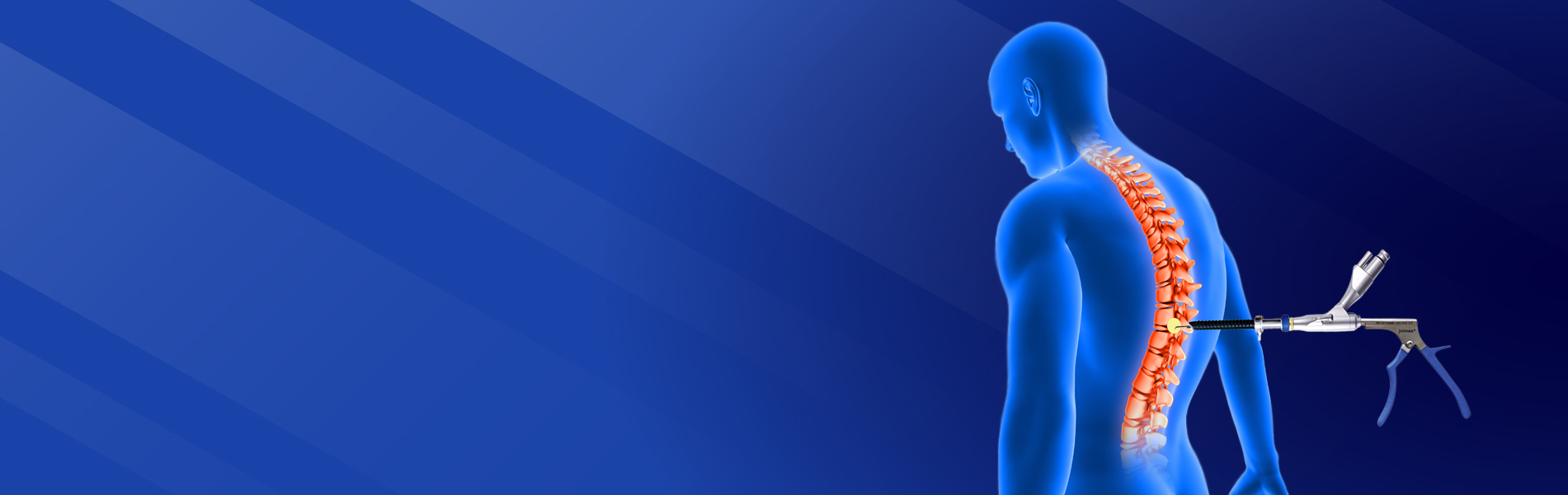 Full Endoscopic Spinal Surgery Pakistan – Dr. Waqas Mehdi