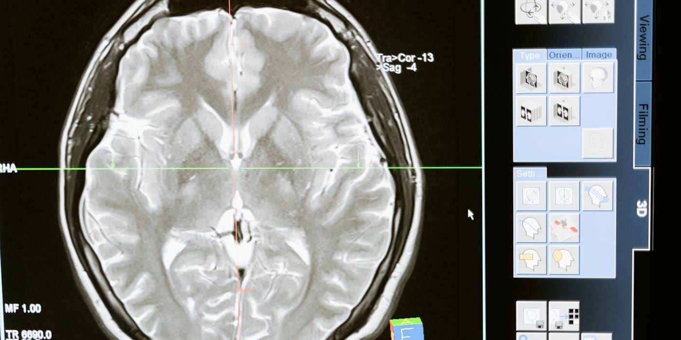 VP Shunt Surgery for Hydrocephalus in Pakistan: A Parent's Guide